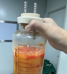 海南水动力吸脂手术要做多久？